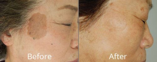 forever-young-bbl-photofacial-before-after-full-2