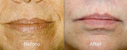 forever-young-bbl-photofacial-before-after-full-6